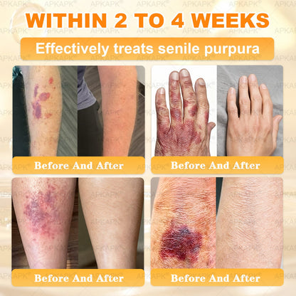 APKAPK®--Only 10 jars! Grab an exclusive 30% discount now! Keep your skin youthful and glowing in just 1 to 3 weeks. Don’t miss your chance—this offer won’t come around again until next year. Act fast! 180-day money back guarantee!