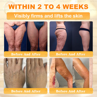 🌟Official Store | 𝐀𝐏𝐊𝐀𝐏𝐊® 𝟖-𝐈𝐧-𝟏 𝐁𝐞𝐞 𝐕𝐞𝐧𝐨𝐦 & 𝐓𝐚𝐥𝐥𝐨𝐰 𝐒𝐤𝐢𝐧 𝐅𝐢𝐫𝐦𝐢𝐧𝐠 & 𝐓𝐫𝐞𝐚𝐭𝐦𝐞𝐧𝐭 𝐂𝐫𝐞𝐚𝐦 (Effective Within 7 Days)Bee Venom + Tallow · 7X Deep Hydration, targets wrinkles, sagging, stretch marks, dark spots, purpura, inflammations and more