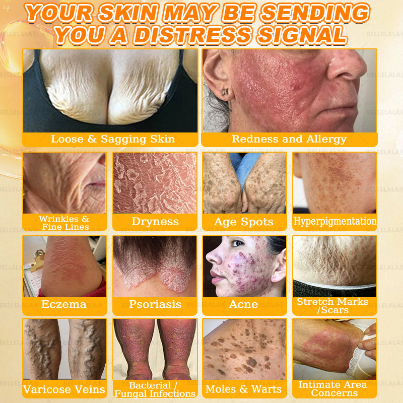 Official Store | 𝗕𝗘𝗟𝗟𝗘𝗟𝗔𝗟𝗔® 𝗕𝗲𝗲 𝗩𝗲𝗻𝗼𝗺 & 𝗣𝗿𝗼𝗽𝗼𝗹𝗶𝘀 𝗠𝘂𝗹𝘁𝗶-𝗔𝗰𝘁𝗶𝗼𝗻 𝗦𝗸𝗶𝗻 𝗥𝗲𝗽𝗮𝗶𝗿 𝗖𝗿𝗲𝗮𝗺 (Effective Within 7 Days)Bee Venom + 𝗣𝗿𝗼𝗽𝗼𝗹𝗶𝘀 · 7X Deep Hydration, targets wrinkles, sagging, stretch marks, dark spots, purpura, inflammations and more